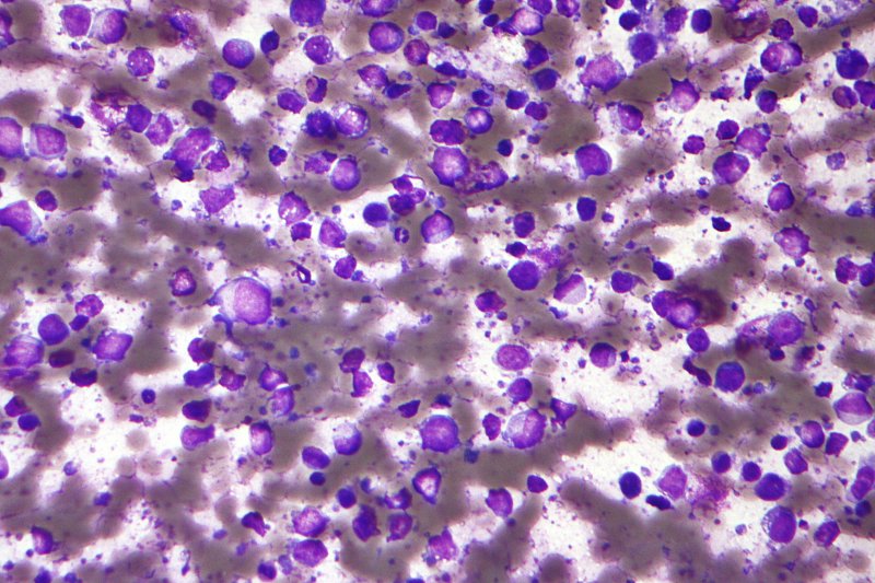 diffuse-large B-cell lymphoma